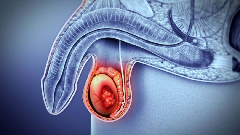 Reporte de un caso de rabdomiosarcoma primario testicular recurrente