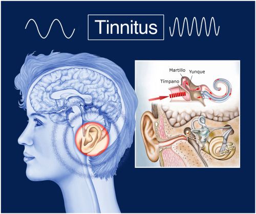 Dehiscencia del canal semicircular superior como causa de tinnitus pulsátil