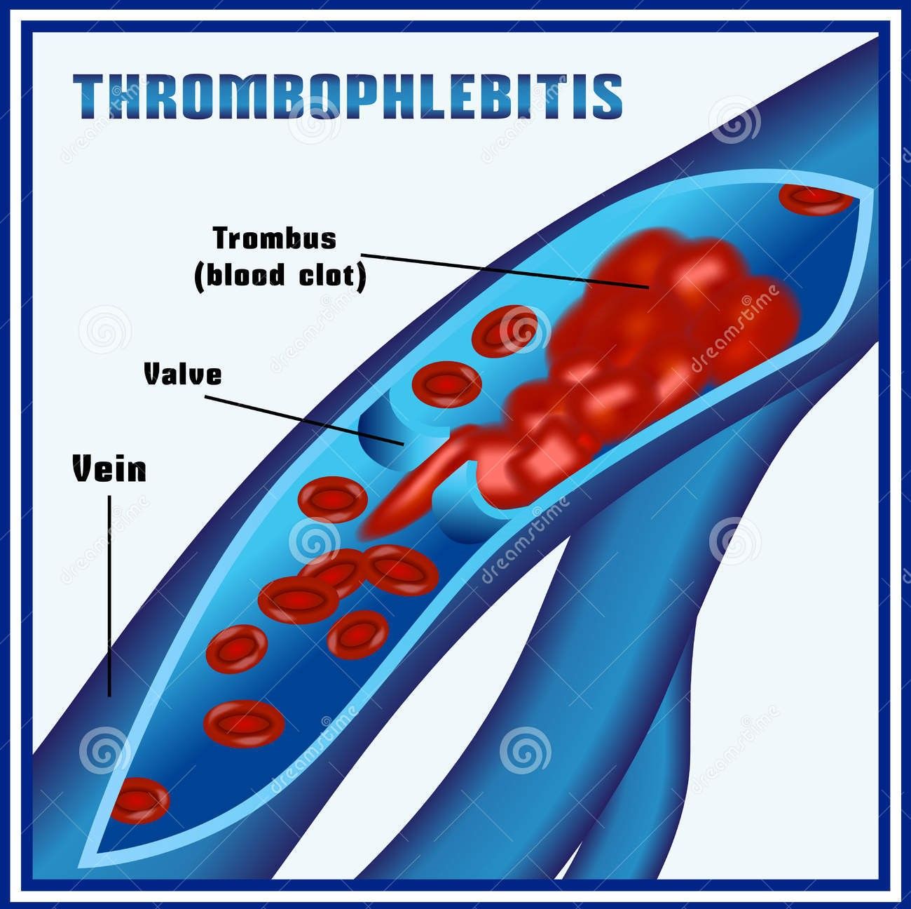 Tromboflebitis superficial de la vena toracoepigástrica: enfermedad de Mondor