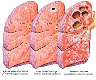 Tuberculosis Pulmonar y Extrapulmonar. Reporte de un caso