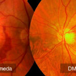 Los antioxidantes podrían ralentizar la progresión de la degeneración macular asociada a la edad