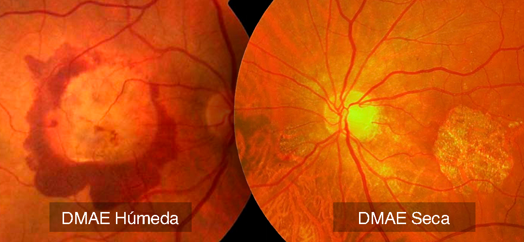 Los antioxidantes podrían ralentizar la progresión de la degeneración macular asociada a la edad