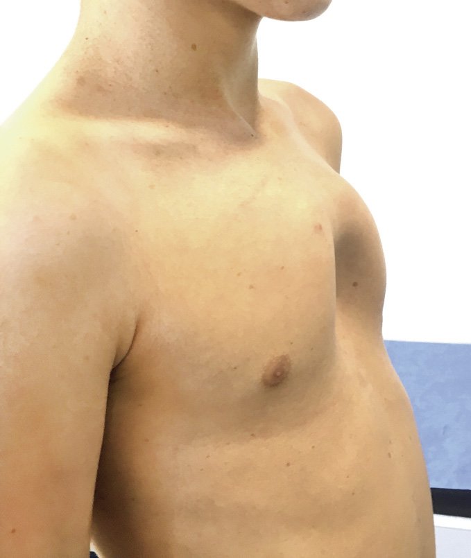 Cirugía de contorno corporal en pectus excavatum mediante prótesis preformadas de silicona