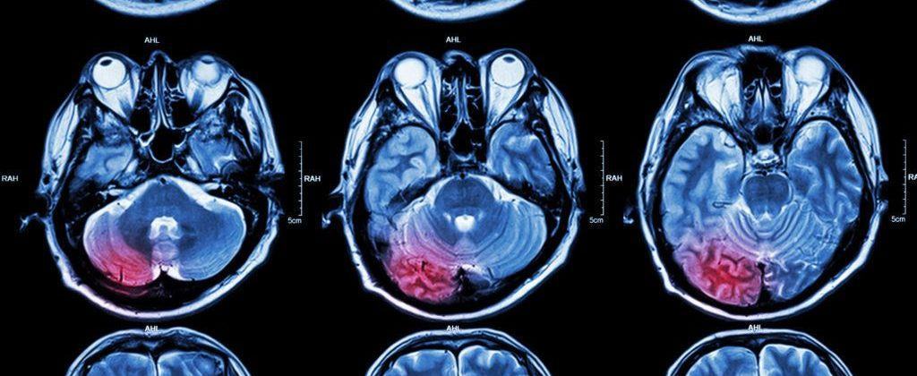 Terapia triple para tratar el carcinoma hepatocelular de alto riesgo