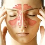 Absceso orbitario subperióstico lateral secundario a tumor inflamatorio de Pott: complicación de una sinusitis frontal aguda