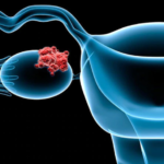 Atezolizumab versus placebo en combinación con bevacizumab y quimioterapia sin platino en el cáncer de ovario recurrente: resultados finales de supervivencia global y libre de progresión del estudio AGO-OVAR 2.29/ENGOT-ov34