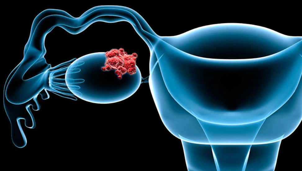 Atezolizumab versus placebo en combinación con bevacizumab y quimioterapia sin platino en el cáncer de ovario recurrente: resultados finales de supervivencia global y libre de progresión del estudio AGO-OVAR 2.29/ENGOT-ov34