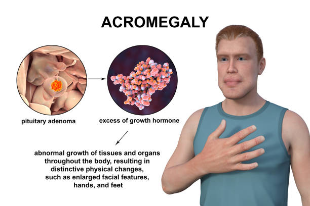 Acromegalia: impacto en la piel y más allá