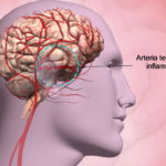 Arteritis células gigantes: Más allá de lo típico