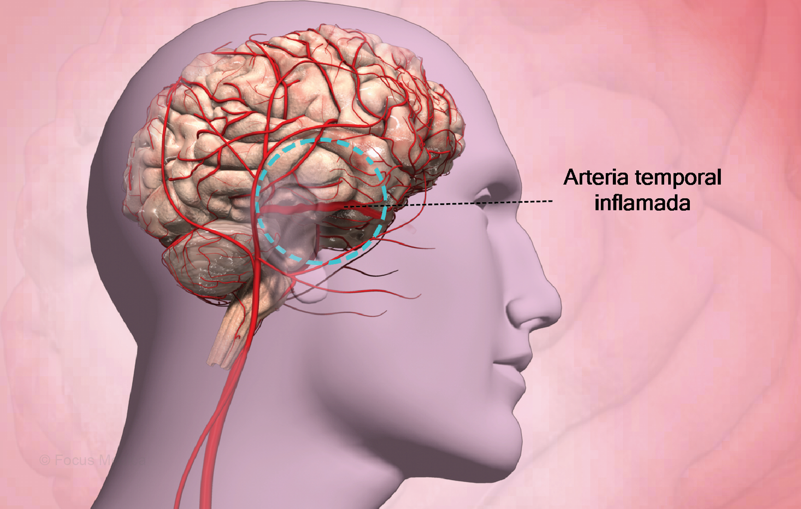 Arteritis células gigantes: Más allá de lo típico