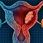 Resultados de supervivencia a largo plazo de la terapia hormonal en pacientes premenopáusicas con cáncer de endometrio en estadio clínico I.