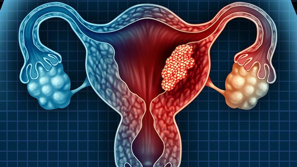 Resultados de supervivencia a largo plazo de la terapia hormonal en pacientes premenopáusicas con cáncer de endometrio en estadio clínico I.