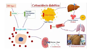 Cetoacidosis diabética en un paciente con acromegalia: Un desafío diagnóstico y terapéutico