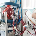 Soporte circulatorio con ECMO venovenoso en paciente con síndrome de reperfusión pulmonar secundario a tromboendarterectomía arterial pulmonar