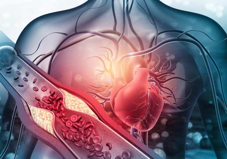 La disincronía ventricular izquierda evaluada a través de los Estudios de Perfusión Miocárdica SPECT Gatillado