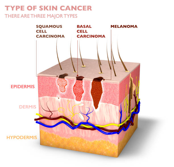 Identifican un nuevo biomarcador pronóstico de recaída en el carcinoma escamoso cutáneo y los mecanismos responsables de la progresión tumoral