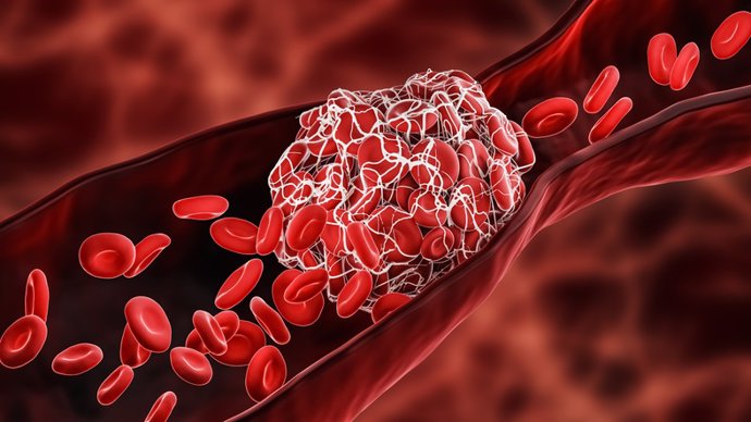 Alteraciones de la hemostasia en pacientes graves con hemopatías malignas: trastornos trombóticos