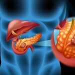 A examen la quimioterapia triple en el cáncer pancreático avanzado