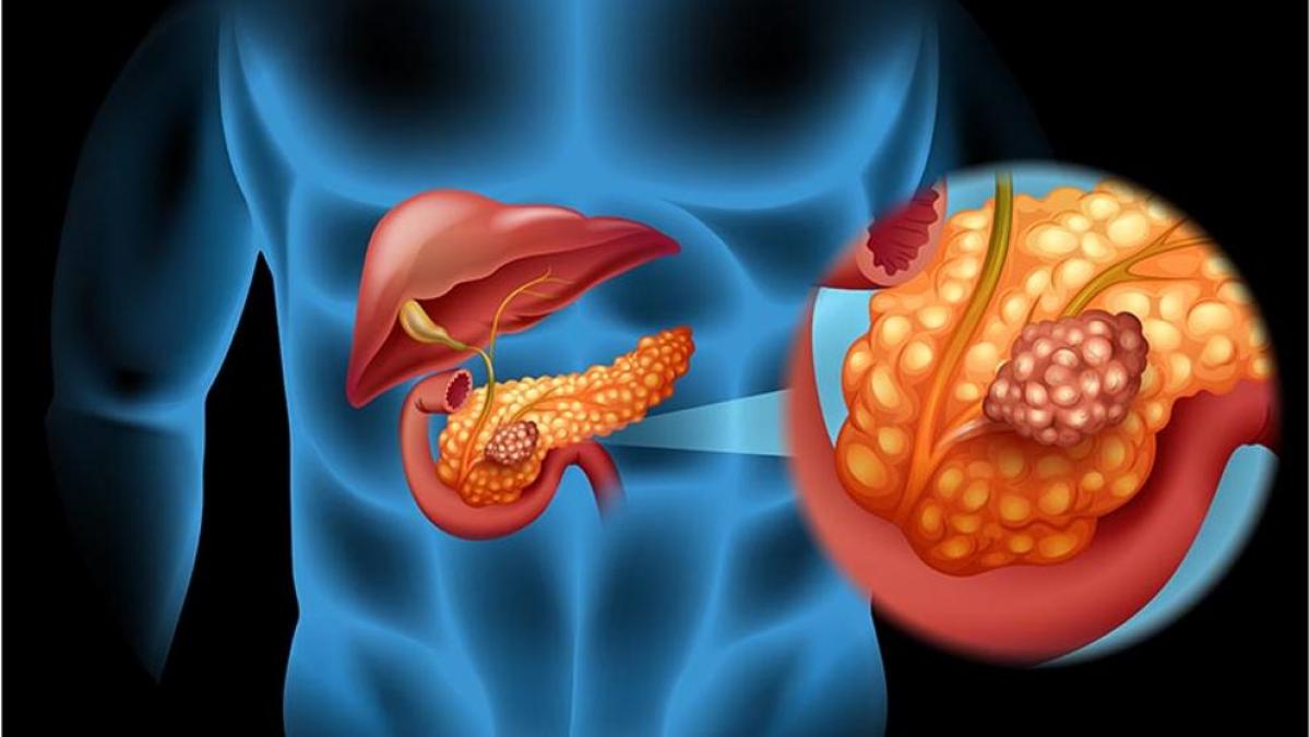 A examen la quimioterapia triple en el cáncer pancreático avanzado