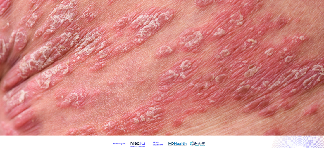 Psoriasis pustulosa generalizada: síntomas, diagnóstico y tratamiento